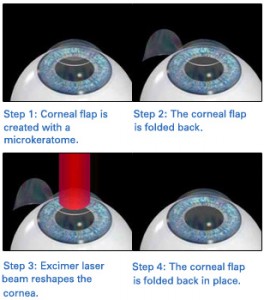 Details Of LASIK Surgery